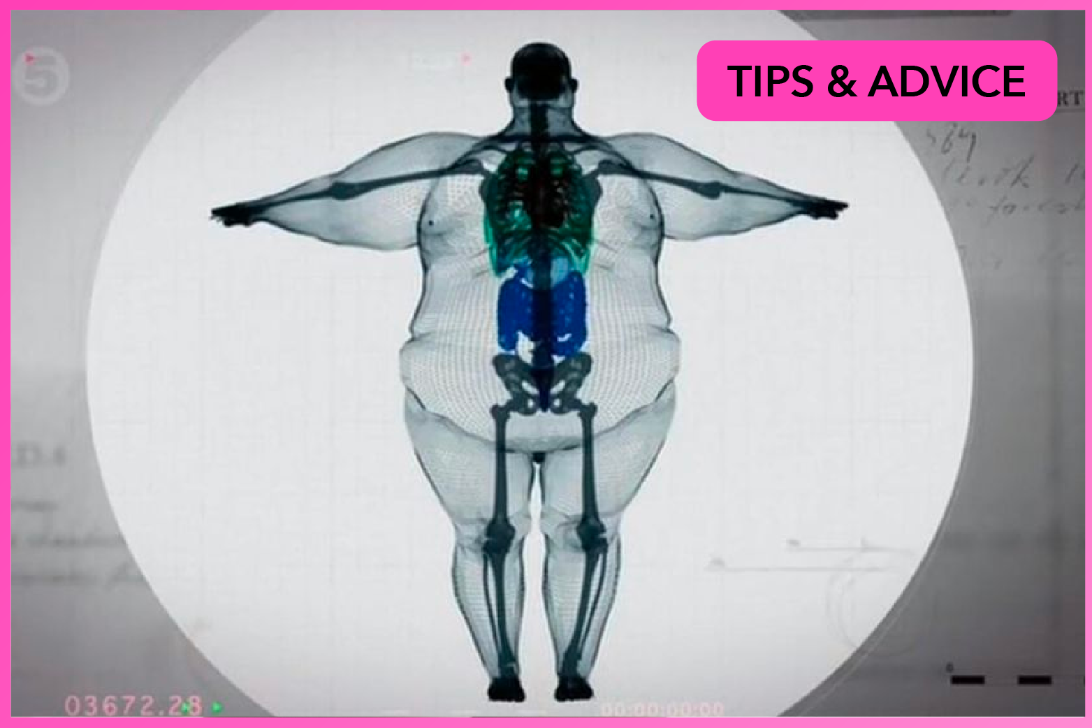 Yes, You Can Be 'Big Boned' (But That's Not Why You're Overweight